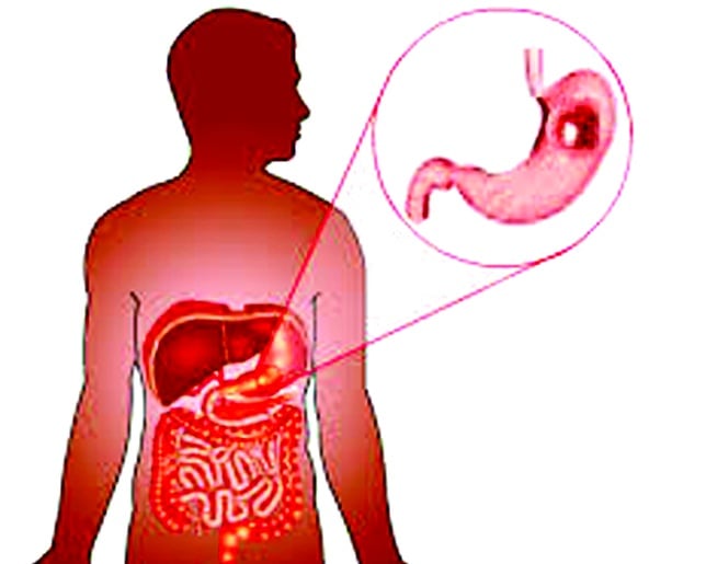 Gastric polyp - Ảnh minh họa 3