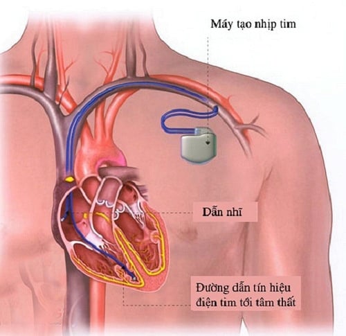 Block nhĩ thất cấp 3 (hoàn toàn) - Ảnh minh họa 1