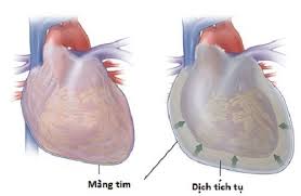 Chèn ép tim - Ảnh minh họa 1