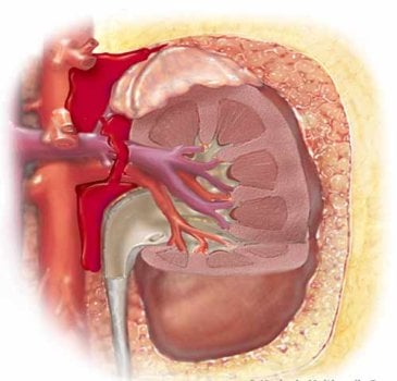 Hoại tử ống thận cấp - Ảnh minh họa 3