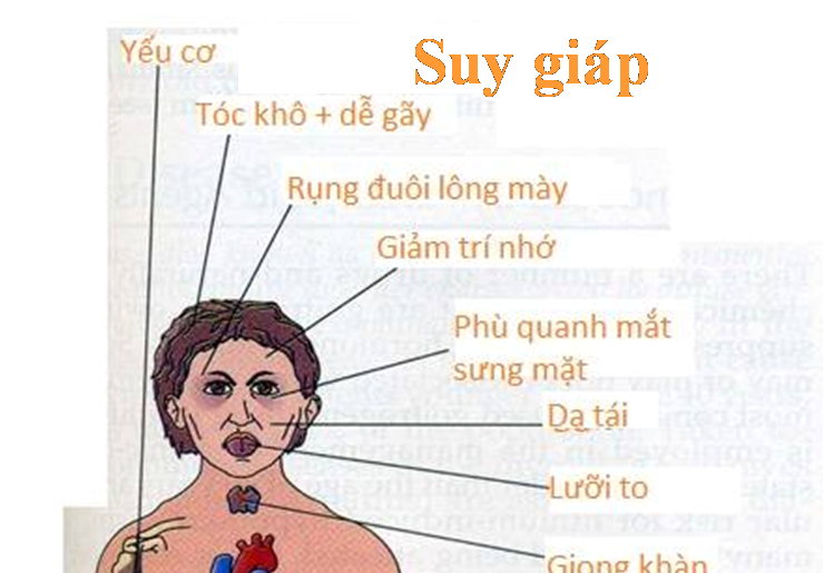 Hôn mê do suy giáp - Ảnh minh họa 1