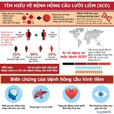 Hồng cầu hình liềm - Ảnh minh họa 4