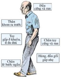 Hội chứng Parkinson - Ảnh minh họa 3