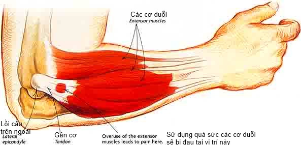 Hội chứng đau khuỷu tay chơi Gôn - Ảnh minh họa 4