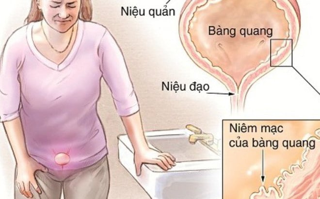 Hội chứng đau bàng quang - Ảnh minh họa 1