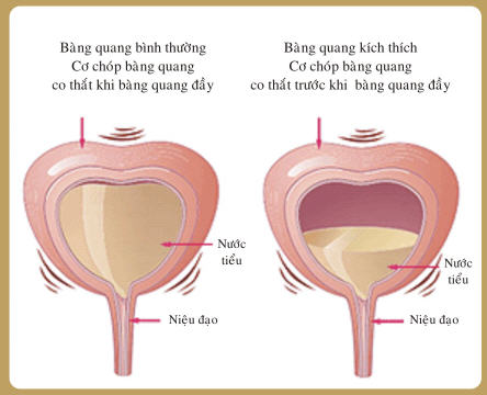 Hội chứng đau bàng quang - Ảnh minh họa 2