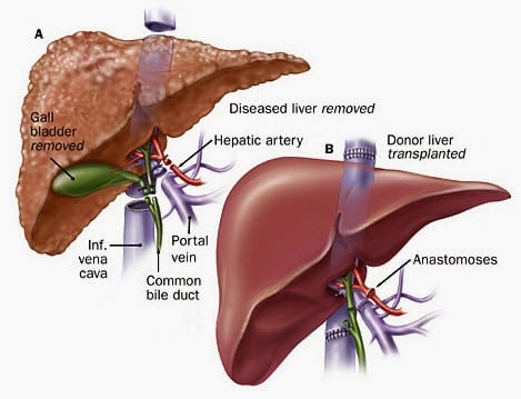 Hepatitis A - Ảnh minh họa 1