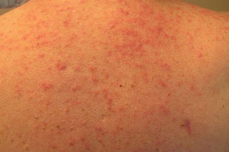 Hot tub folliculitis - Ảnh minh họa 1