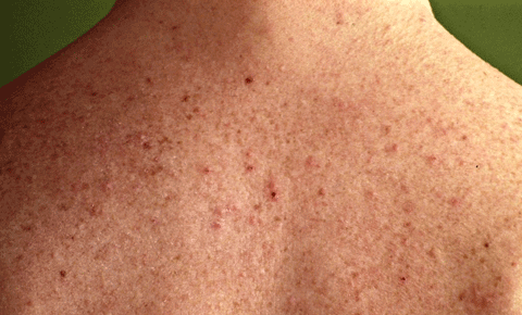 Hot tub folliculitis - Ảnh minh họa 2