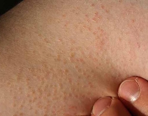 Hot tub folliculitis - Ảnh minh họa 3