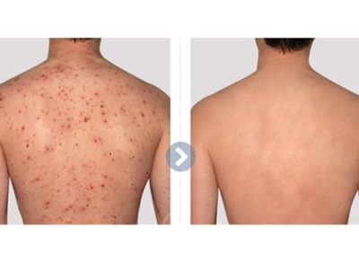 Hot tub folliculitis - Ảnh minh họa 4