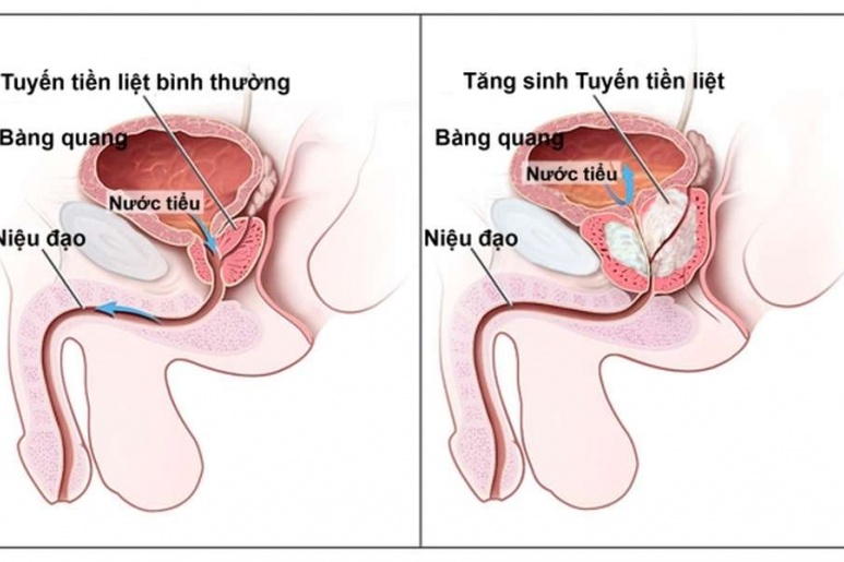 Inflammatory disease of prostate - Ảnh minh họa 2