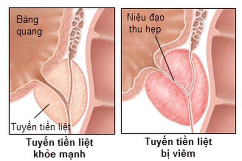 Inflammatory disease of prostate - Ảnh minh họa 4