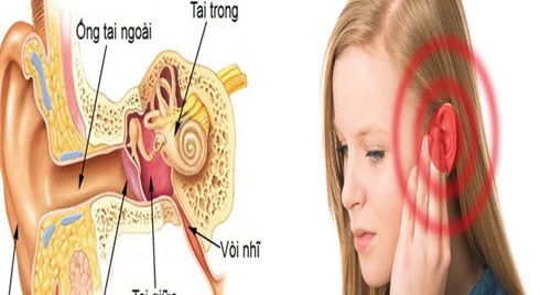 Hematotympanum - Ảnh minh họa 4