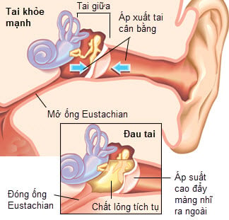 Hematotympanum - Ảnh minh họa 3