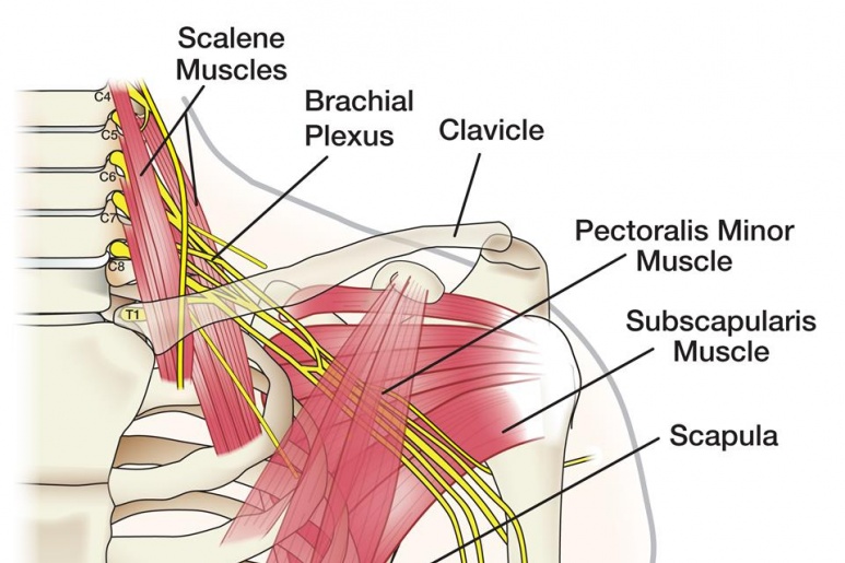 Chấn thương đám rối thần kinh cánh tay - Ảnh minh họa 4