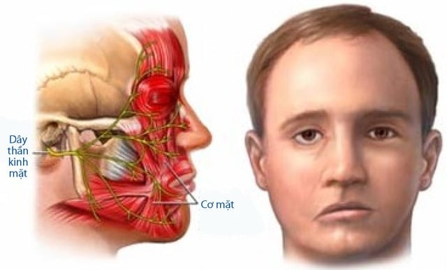 Co thắt nửa mặt - Ảnh minh họa 1