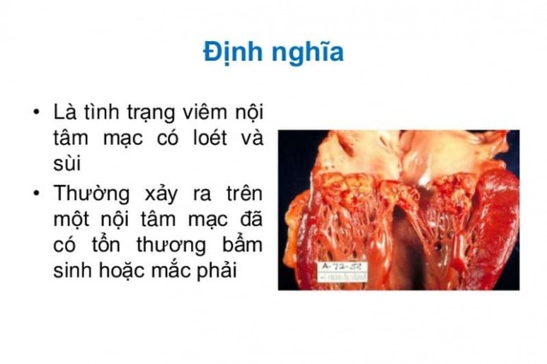 Infective endocarditis - Ảnh minh họa 3