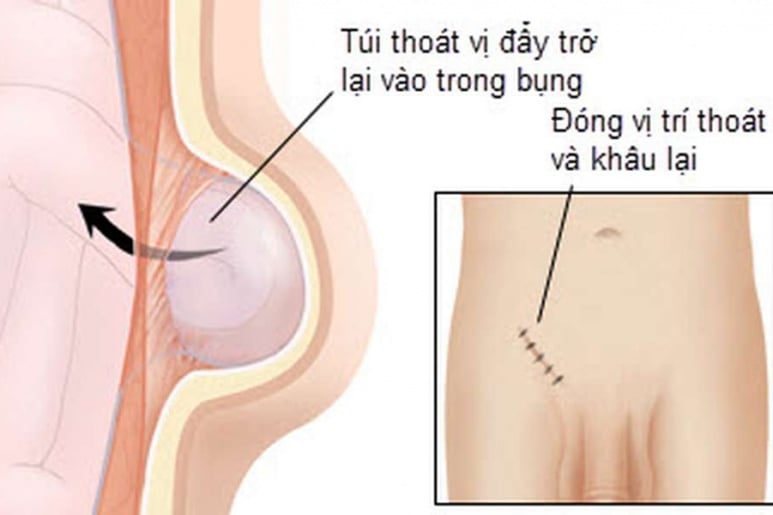 Incisional hernia - Ảnh minh họa 2