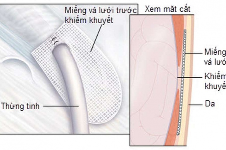 Incisional hernia - Ảnh minh họa 3