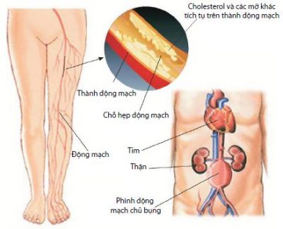 Thuyên tắc động mạch phổi - Ảnh minh họa 4