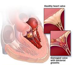 Infective endocarditis - Ảnh minh họa 2