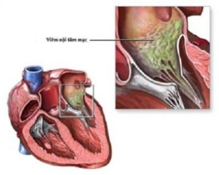 Infective endocarditis - Ảnh minh họa 3