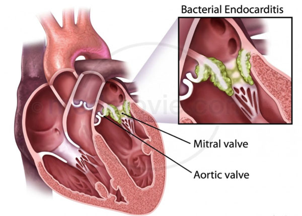 Infective endocarditis - Ảnh minh họa 4