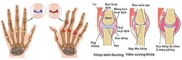 Thấp khớp - Ảnh minh họa 3