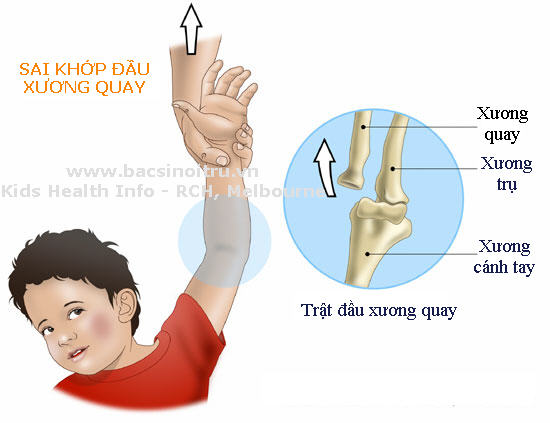 Trật khớp đầu xương khuỷu tay - Ảnh minh họa 1