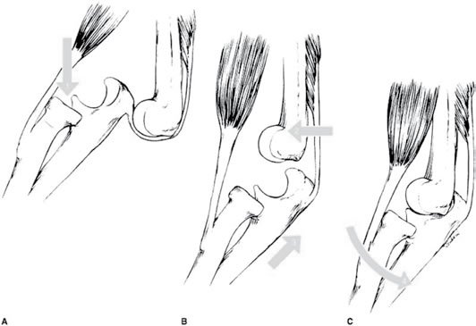 Trật khớp đầu xương khuỷu tay - Ảnh minh họa 4