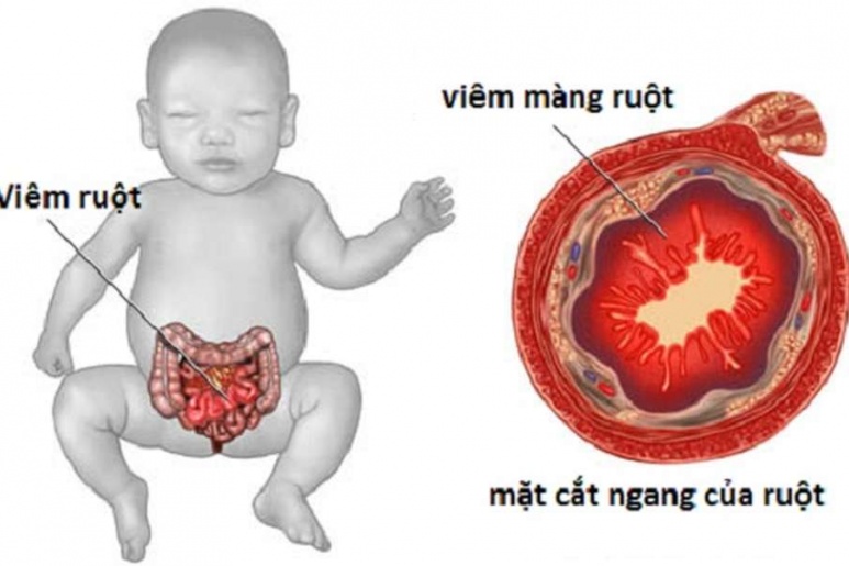 IBD - Ảnh minh họa 2