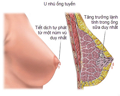 Giãn ống dẫn sữa - Ảnh minh họa 2