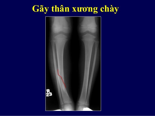 Gãy xương chày - Ảnh minh họa 2