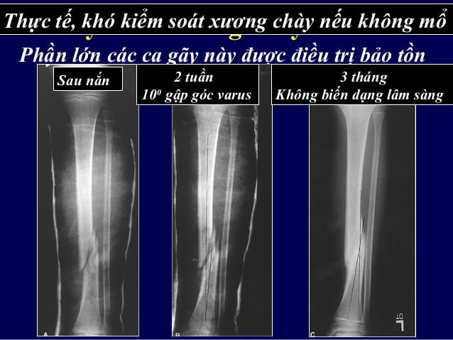 Gãy xương chày - Ảnh minh họa 4