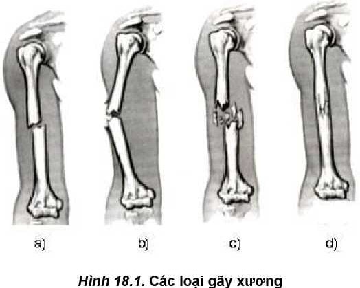 Gãy xương cành tươi - Ảnh minh họa 2