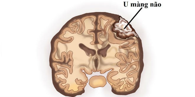 U màng não - Ảnh minh họa 2