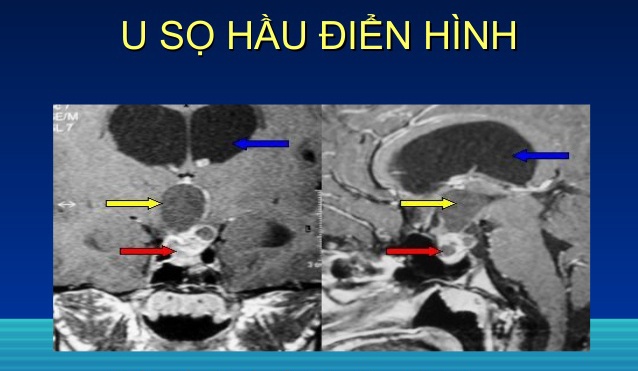 u sọ hầu - Ảnh minh họa 1