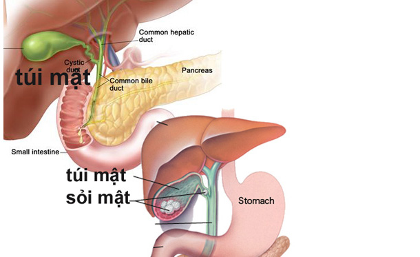 Ung thư túi mật - Ảnh minh họa 4