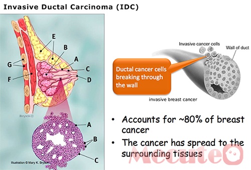 Ung thư biểu mô tiểu thùy xâm lấn - Ảnh minh họa 4