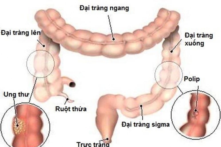 Ung thư đại trực tràng - Ảnh minh họa 4