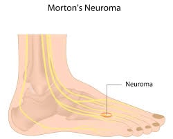 U dây thần kinh Morton - Ảnh minh họa 2