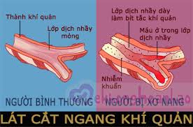 U xơ nang - Ảnh minh họa 3