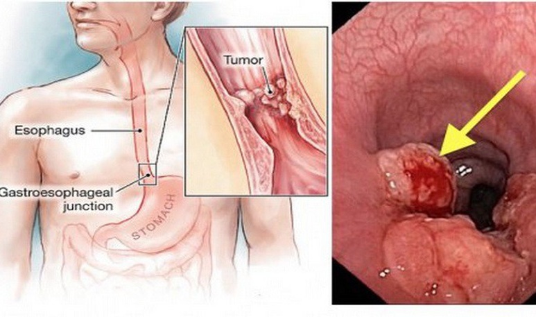 Ung thư thực quản - Ảnh minh họa 3