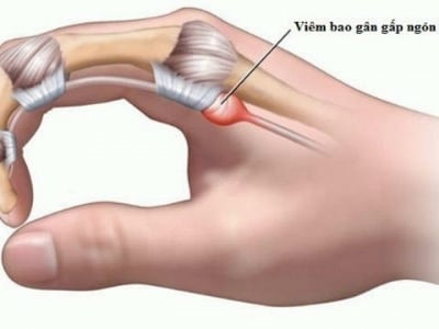 Hội chứng Trichorhinophalangeal loại III - Ảnh minh họa 1