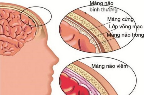 Hội chứng nhiều màng - Ảnh minh họa 2