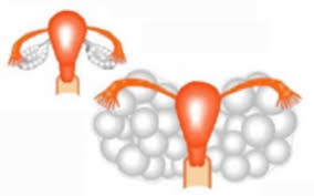 Hội chứng quá kích buồng trứng - Ảnh minh họa 1