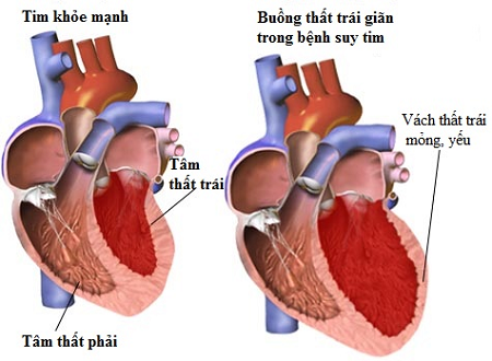 Hội chứng suy tim trái - Ảnh minh họa 1