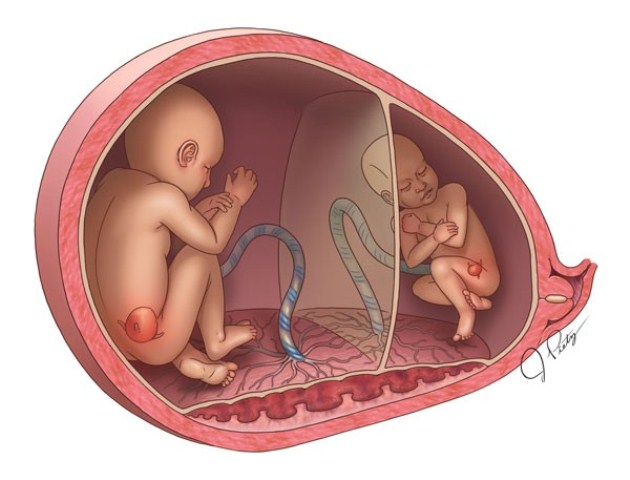 Hội chứng truyền máu song thai (TTTS) - Ảnh minh họa 2