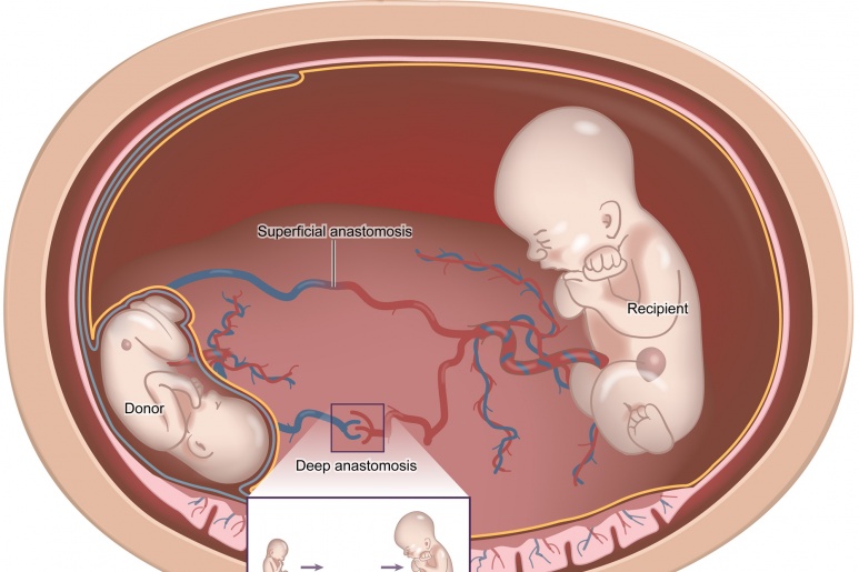 Hội chứng truyền máu song thai (TTTS) - Ảnh minh họa 1
